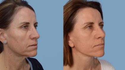 Facelift-Gallery-lp-ba-img