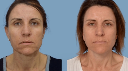 Facelift-Gallery-lp-ba-img