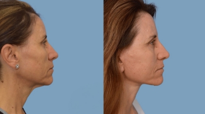 Facelift-Gallery-lp-ba-img