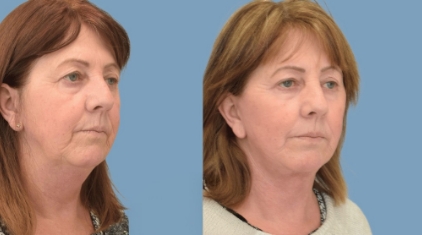 Facelift-Gallery-lp-ba-img