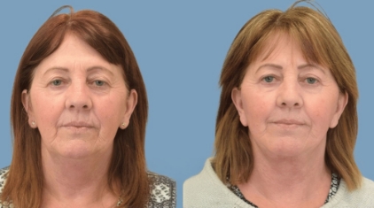 Facelift-Gallery-lp-ba-img