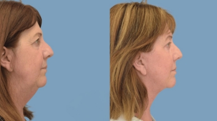 Facelift-Gallery-lp-ba-img