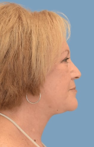 Facelift Sydney banner img