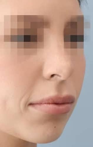alarplastyrhinoplastyafter-img