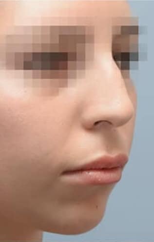 alarplastyrhinoplastybefore-img