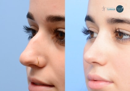 rhinoplasty1-ba-img