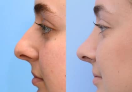 rhinoplasty2-ba-img
