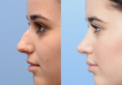 rhinoplasty3-ba-img