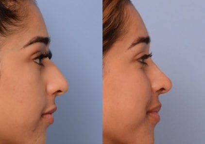 rhinoplasty5-ba-img