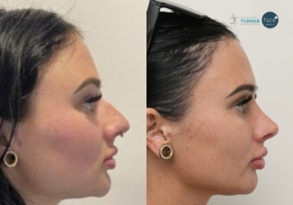 rhinoplasty6-ba-img