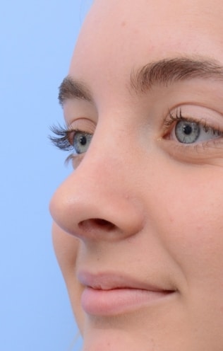 rhinoplastyafter-img