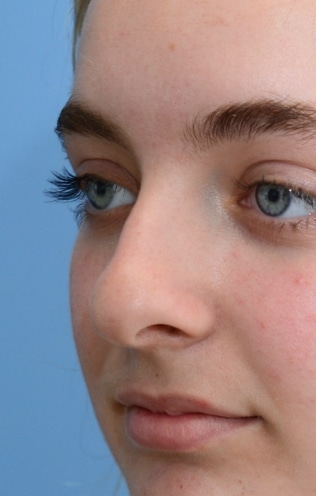 rhinoplastybefore-img