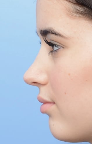 septoplastyrhinoplastyafter-img