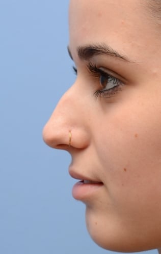 septoplastyrhinoplastybefore-img