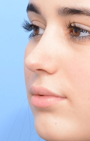 tiprhinoplastyafter-img