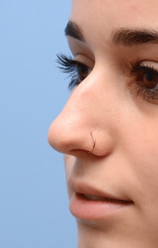 tiprhinoplastybefore-img