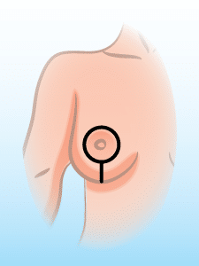 Breast Lift Surgery - Lollipop Breast Lift Scar
