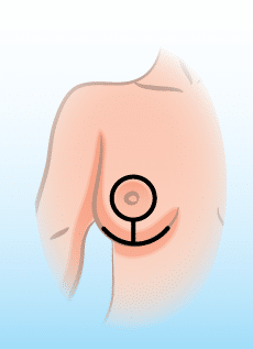 Breast Lift Surgery - Anchor Breast Lift Scar