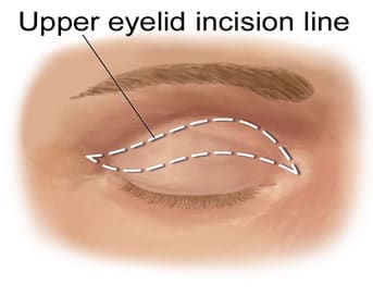 Hooded Eyes Surgery in Sydney by Dr Turner