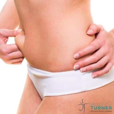 Tummy-Tuck-or-Liposuction stomach_Dr-Turner_Sydney_Feature-Image