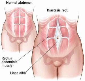 Abdominal Separation post pregnancy