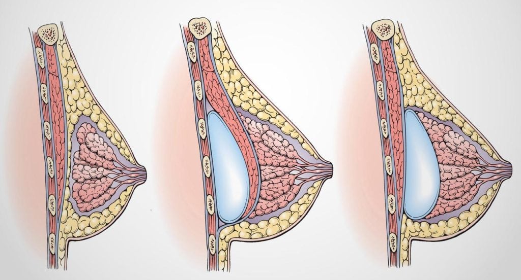 Breast Implant Placement