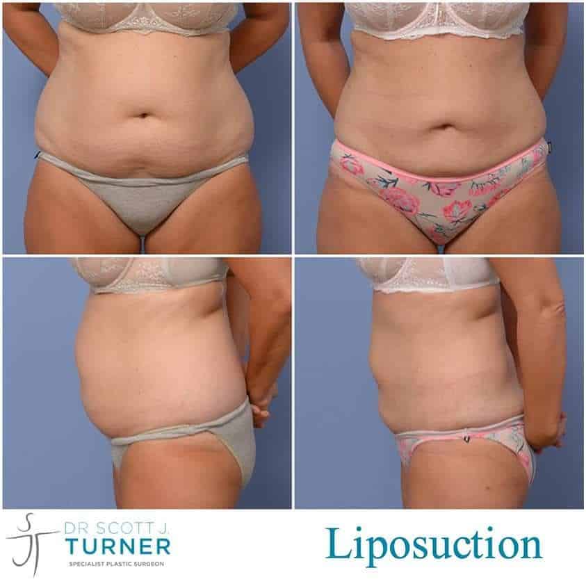Liposuction Before and After by Top liposuction surgeon in Sydney and Newcastle Dr Turner