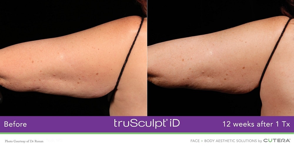 Trusculpt Before and After Arm Results
