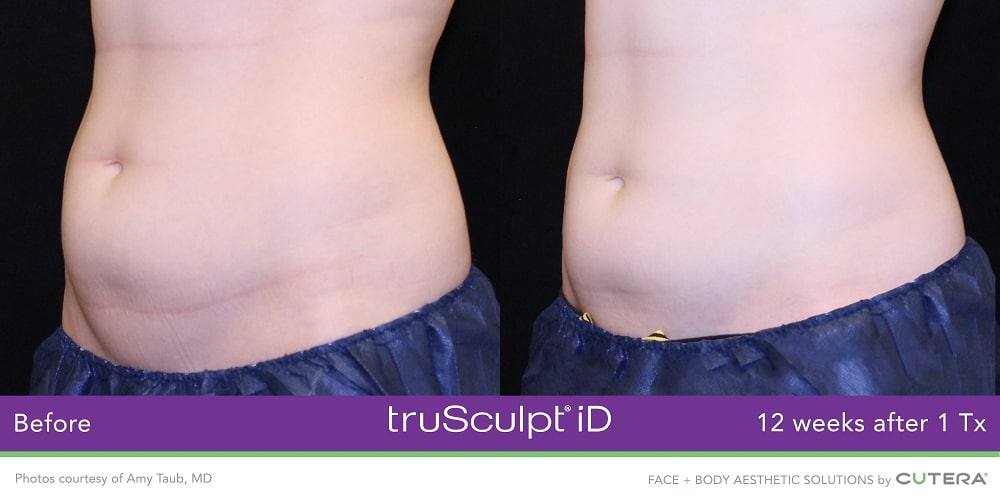 truSculpt before and after abdomen 