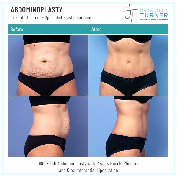 Abdominaplasty Before and After Dr Scott Turner Sydney Tummy Tuck Scar