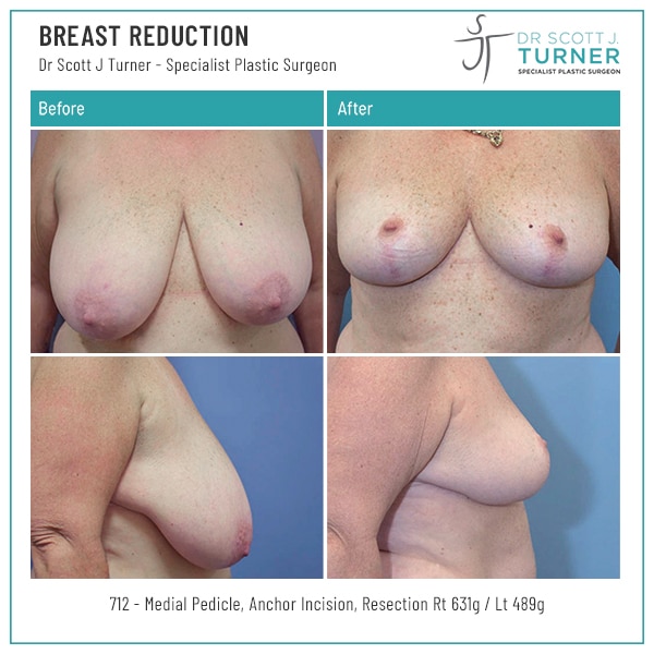 beautiful breasts reduction - Dr Scott Turner Top Plastic Surgeon Sydney NSW