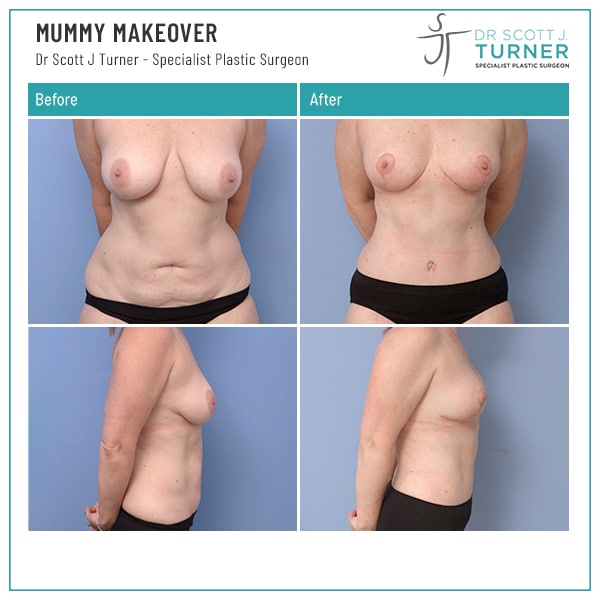 Mummy Makeover Before and After Photos - Dr Scott Turner - Best mummy Makeover Surgeon Sydney