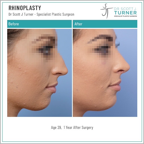Rhinoplasty Surgery Sydney & Newcastle | Nose Job | Dr Turner