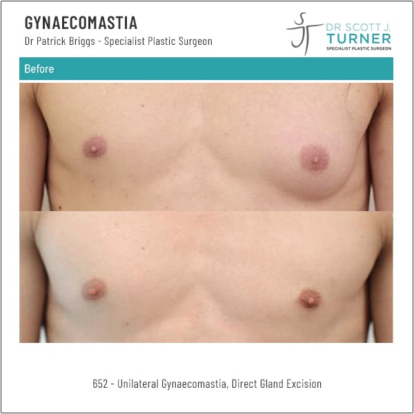 652 Gynaecomastia Before and After Front by Dr Scott Turner Plastic Surgeon