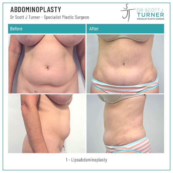 1-Abdominoplasty-Before-and-After-Dr.-Scott-J-Turner