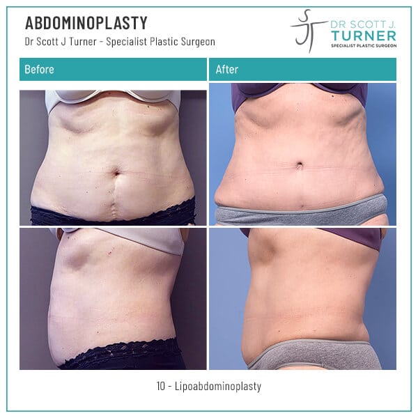 10-Abdominoplasty-Before-and-After-Photo-Dr.-Scott-J-Turner