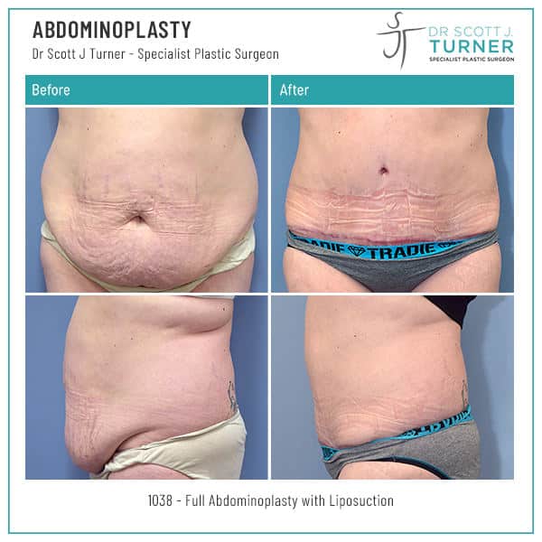 1038-Abdominoplasty-Before-and-After-Photo-Dr.-Scott-J-Turner