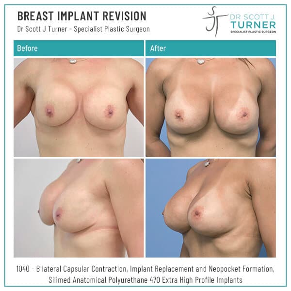 Breast Implant Revision Before and After Dr Turner Sydney