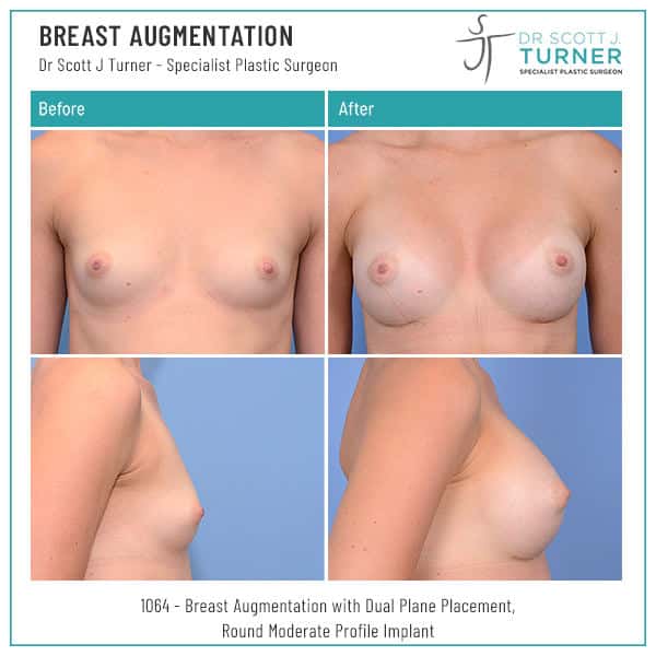 1064 Breast Augmentation Before and After Image-Dr. Scott J Turner