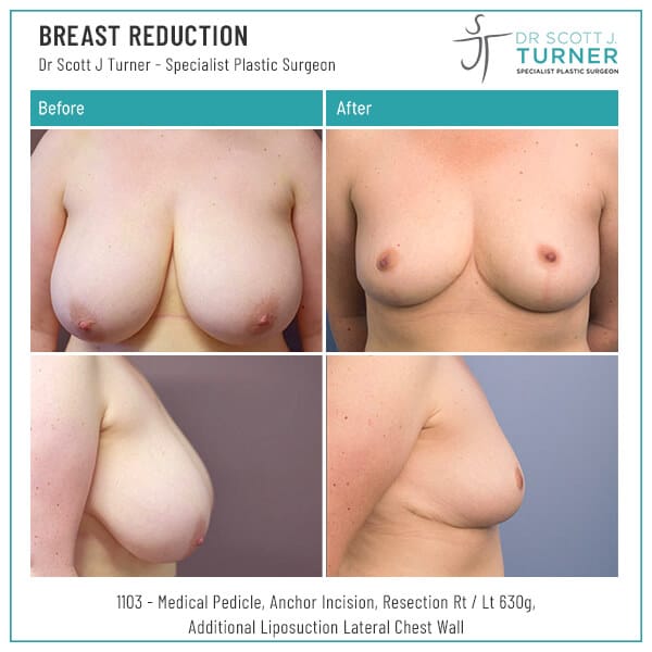 1103-Breast-Reduction-Before-and-After-Photo-Dr.-Scott-J-Turner