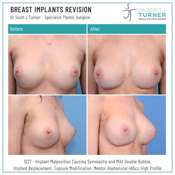 Breast Implants Revision Before and After Dr Turner Sydney - Breast implant revision Newcastle