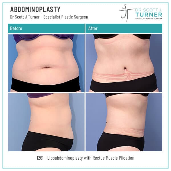 1261-Abdominoplasty-Before-and-After-Photo-Dr.-Scott-J-Turner