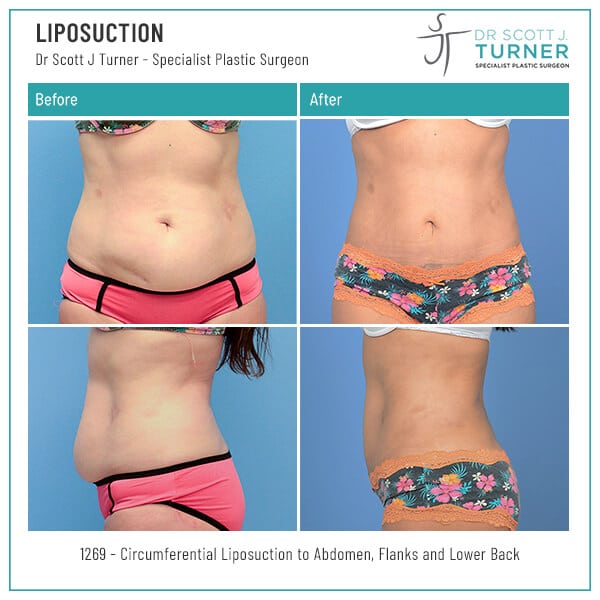 Liposuction-Before-and-After_Dr-Turner_Sydney