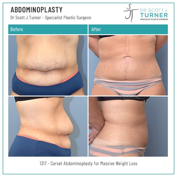 1317-Abdominoplasty-Before-and-After-Photo-Dr.-Scott-J-Turner