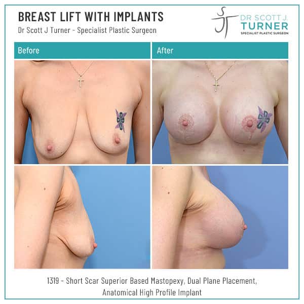 Breast-Lift-with-Implants-Before-and-After_Dr-Turner_Sydney