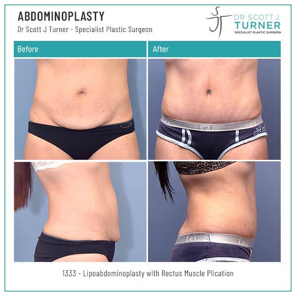 1333-Abdominoplasty-Before-and-After-Photos-Dr.-Scott-J-Turner