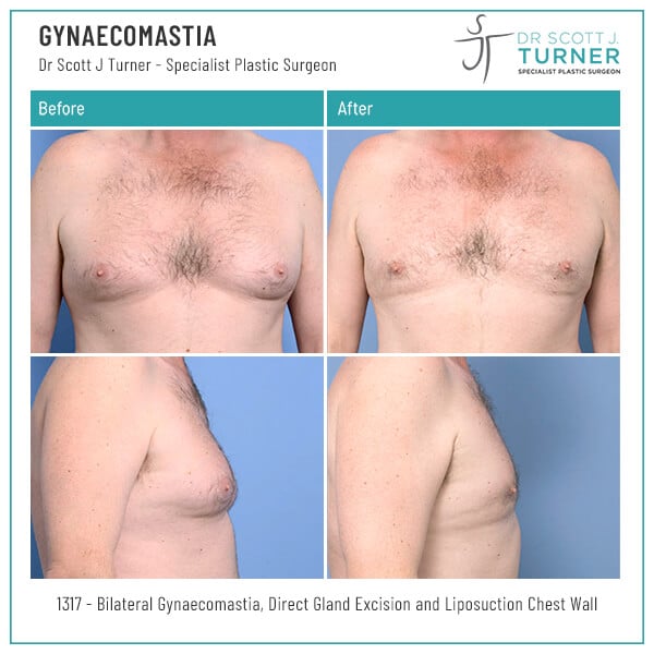 1371-Gynaecomastia-Before-and-After-Photo-Dr.-Scott-J-Turner