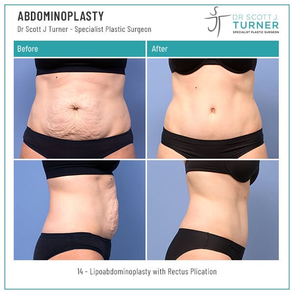 14-Abdominoplasty-Before-and-After-Photo-Dr.-Scott-J-Turner