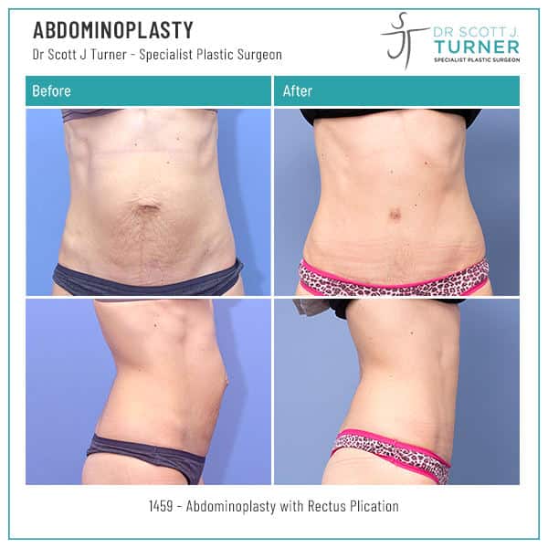 1459-Abdominoplasty-Before-and-After-Image-Dr.-Scott-J-Turner