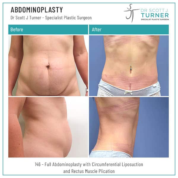 146-Abdominoplasty-Before-and-After-Photos-Dr.Scott-J-Turner